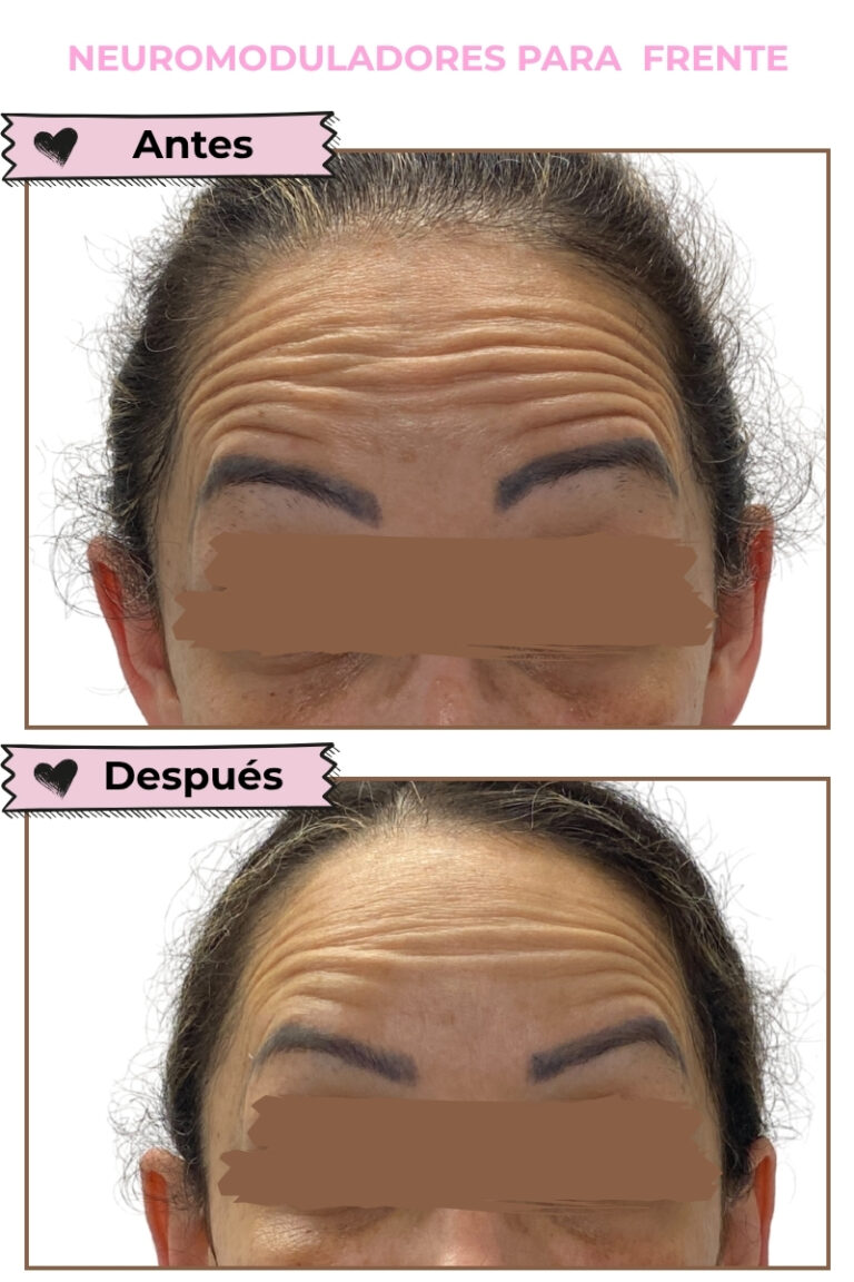 NEUROMODULADOR FRENTE