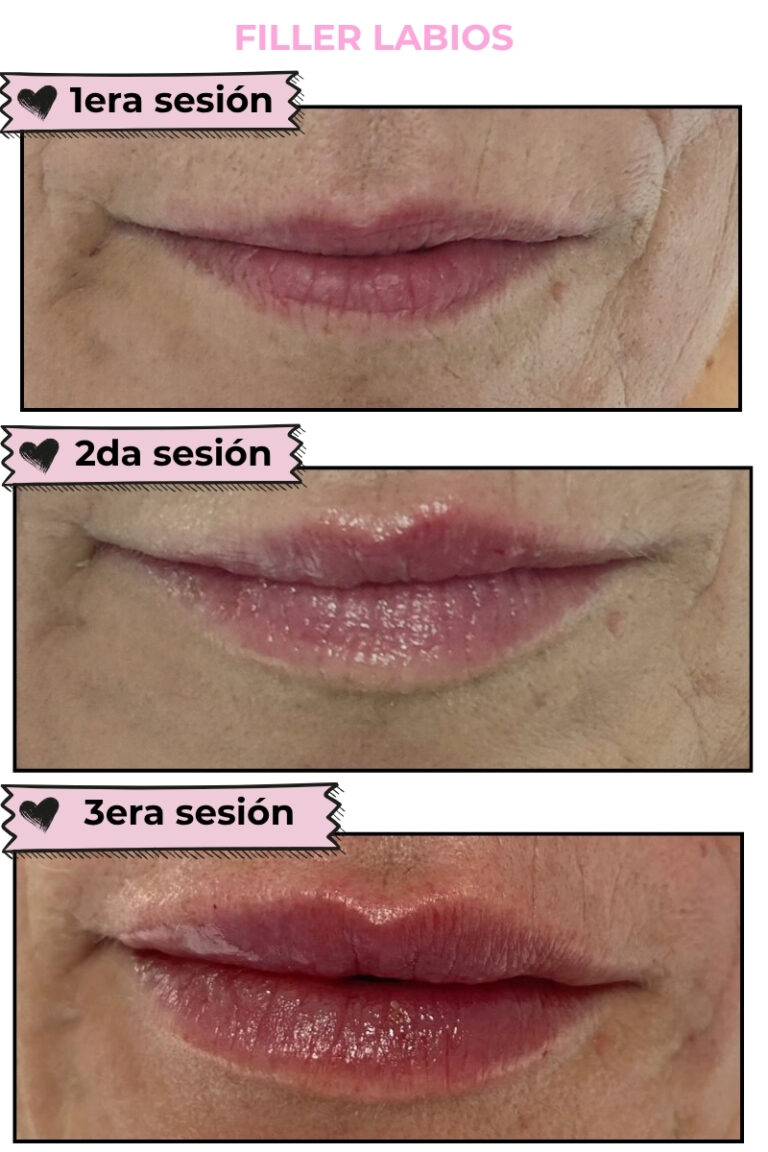FILLER DE LABIOS PACIENTE DRA LINA ARIAS