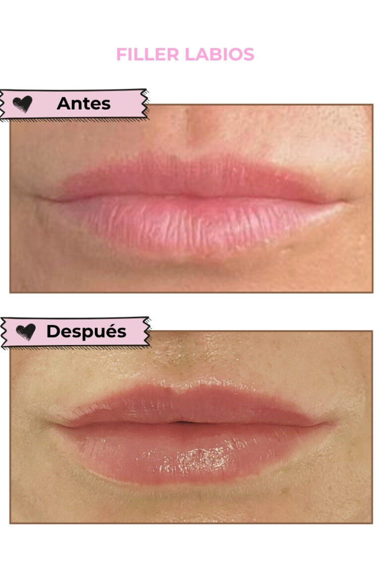 FILLER LABIOS PACIENTE DRA. LINA ARIAS