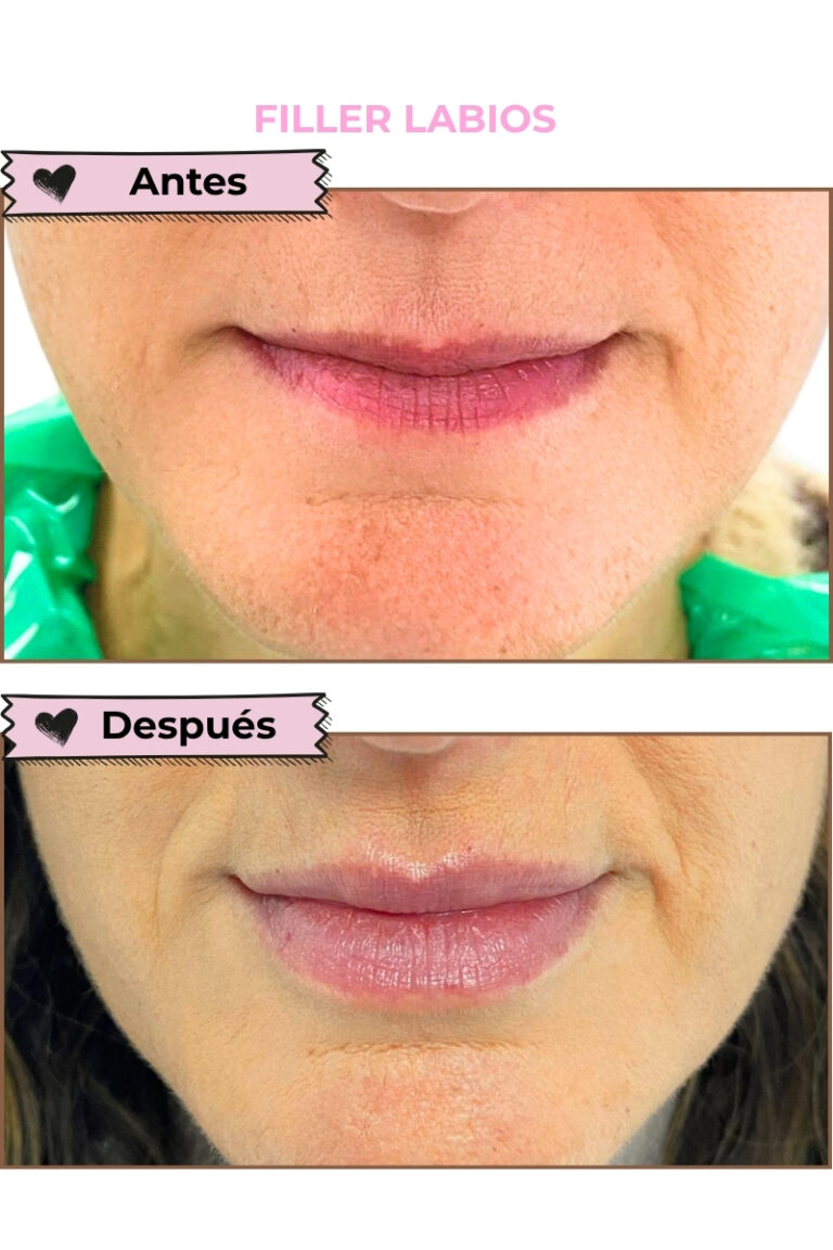 FILLER LABIOS PACIENTE DRA. LINA ARIAS